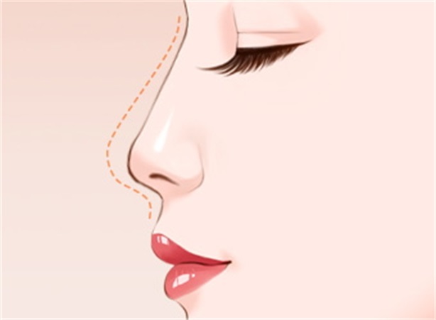鼻整形手术该如何选择？